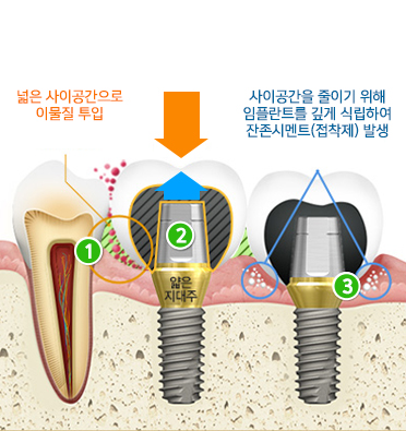 기성 임플란트 이미지 설명