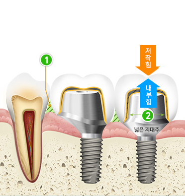 맞춤형 임플란트 이미지 설명