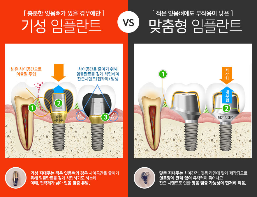 충분한 잇몸뼈가 있을 경우에만 기성 임플란트 : 기성 지대주는 적은 잇몸뼈의 경우 사이공간을 줄이기 
위해 임플란트를 깊게 식립하기도 하는데 이때, 접착제가 남아 잇몸 염증 유발. /vs/ 적은 잇몸뼈에도 부작용이 낮은 맞춤형 임플란트 : 맞춤 지대주는 치아간격, 잇몸 라인에 맞게 제작되므로 
잇몸양에 관계 없이 유착력이 뛰어나고 잔존 시멘트로 인한 잇몸 염증 가능성이 현저히 적음.